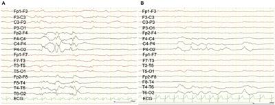 Case Report: Subtotal Hemispherotomy Modulates the Epileptic Spasms in Aicardi Syndrome